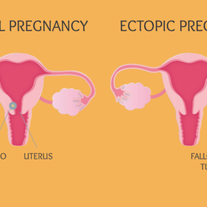 Ectopic Pregnancy