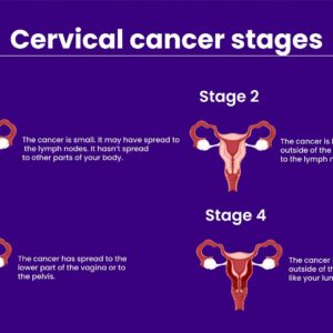 Cervical Cancer