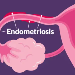 Endometriosis