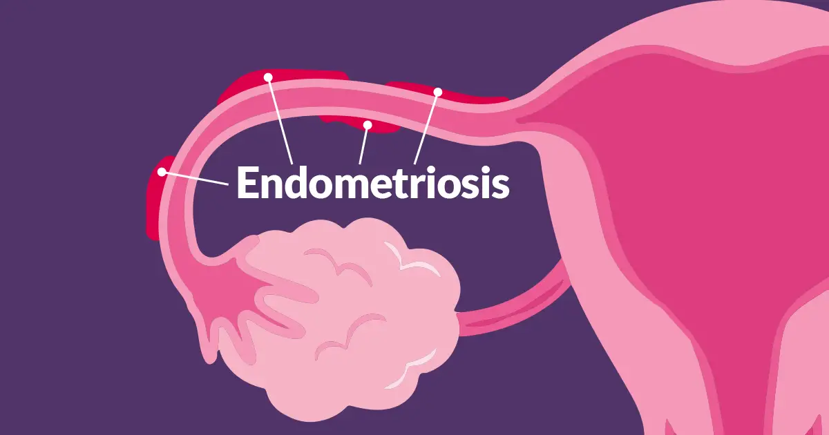 Endometriosis: Symptoms, Causes, and Natural Treatments - Factspree