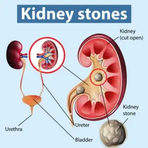 Kidney Stone