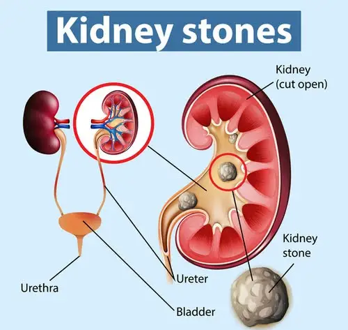 Natural Remedies For Kidney Stones - Factspree..............