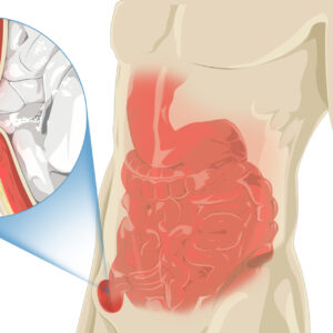 Hernias